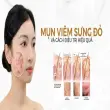 Cách trị mụn viêm tại nhà hiệu quả và ngăn tái phát đơn giản
