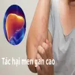 Tác hại men gan cao và những ảnh hưởng sức khỏe bạn cần biết