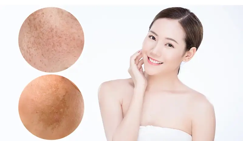 Xác định nguyên nhân gây nám để lựa chọn phương pháp phù hợp