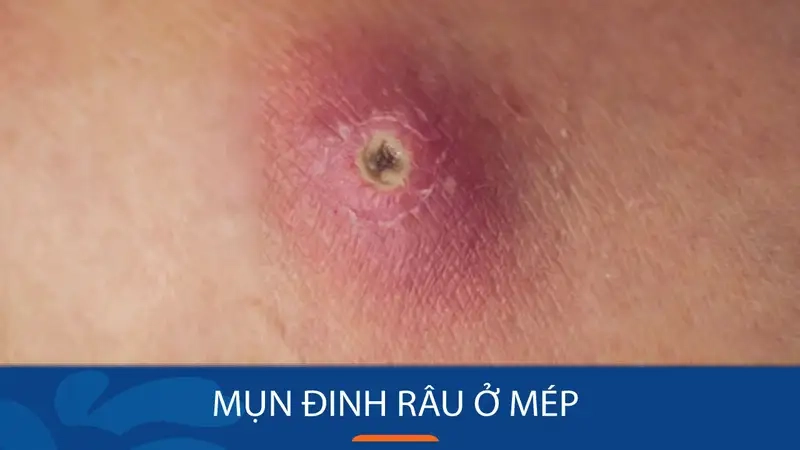 Nguyên nhân và dấu hiệu mụn đinh râu