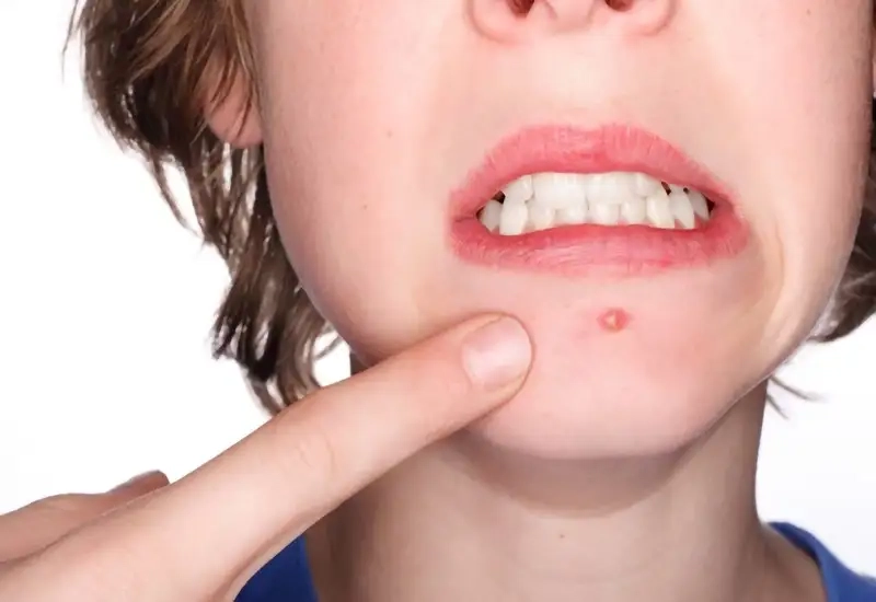 Phương pháp chăm sóc và điều trị tại nhà