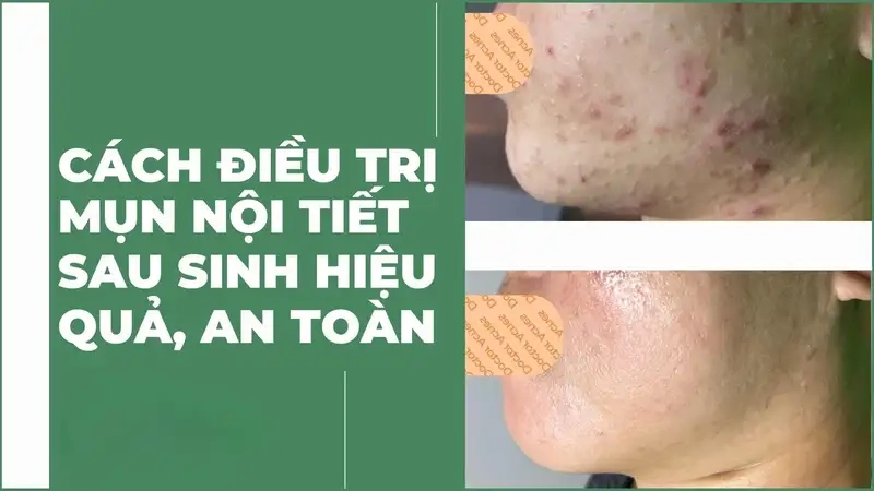 Nguyên nhân gây mụn nội tiết sau sinh