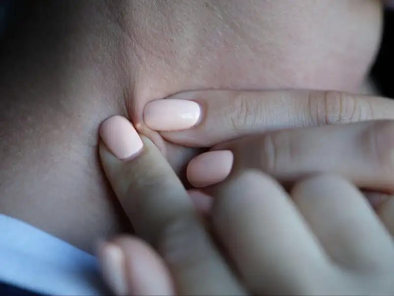 Cách trị mụn ở cổ nhanh nhất tại nhà