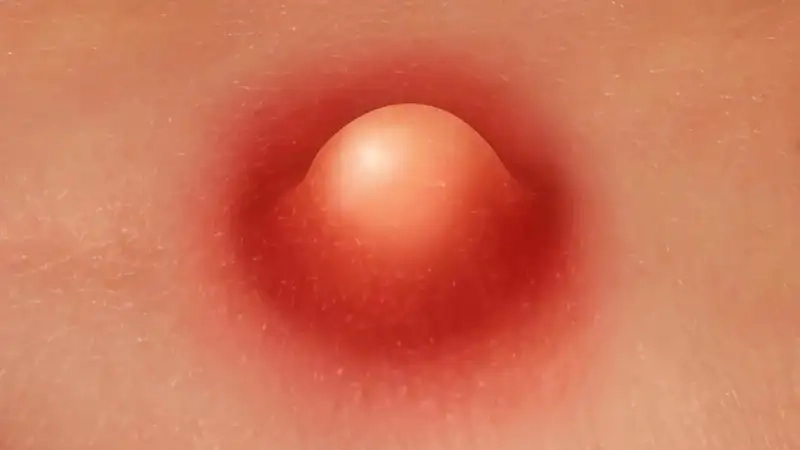 Phòng ngừa bị mụn ở mông