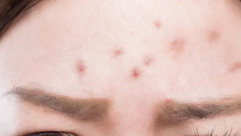 Các phương pháp trị mụn trên trán hiệu quả tại nhà