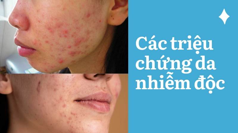 Nhận biết các triệu chứng da nhiễm độc thường gặp