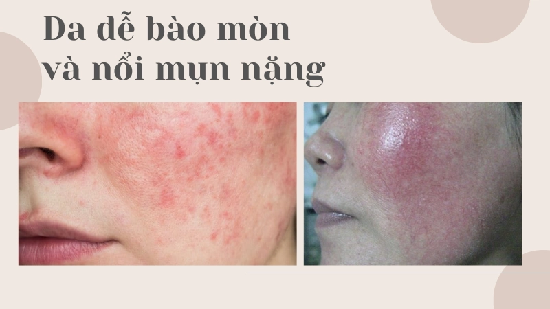 Vì sao da dễ bào mòn và nổi mụn nặng khi dùng kem trộn