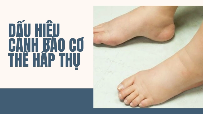 Dấu hiệu sưng phù chân tay cảnh báo cơ thể đang tích nước do thừa muối