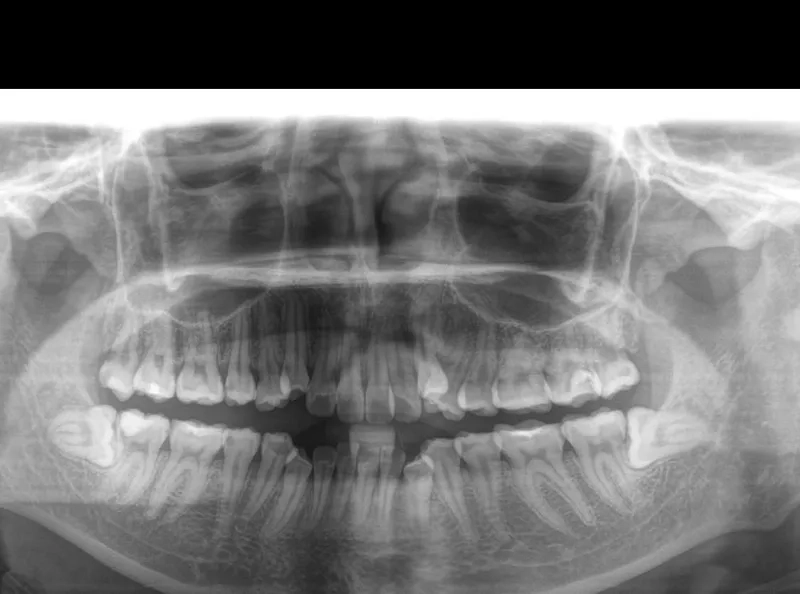 Tìm hiểu những tác hại của răng khôn gây ra