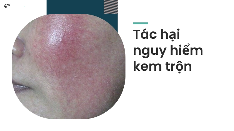 Cảnh báo những tác hại của kem trộn tàn phá gương mặt bạn