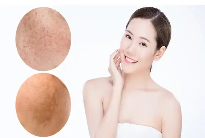 Các bước chăm sóc da nám hiệu quả giúp làn da sáng mịn