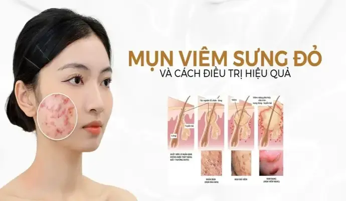Cách trị mụn viêm tại nhà hiệu quả và ngăn tái phát đơn giản