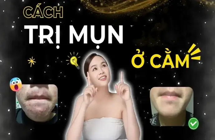 Cách trị mụn ở cằm hiệu quả tại nhà không để lại sẹo