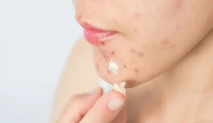 Cách trị mụn ở mép môi nhanh chóng lấy lại làn da xinh