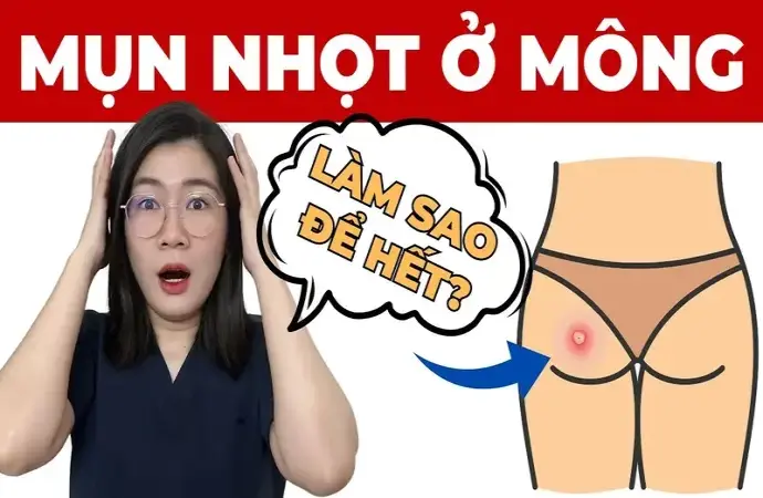 Cách trị mụn ở mông nhanh chóng và hiệu quả ngay tại nhà