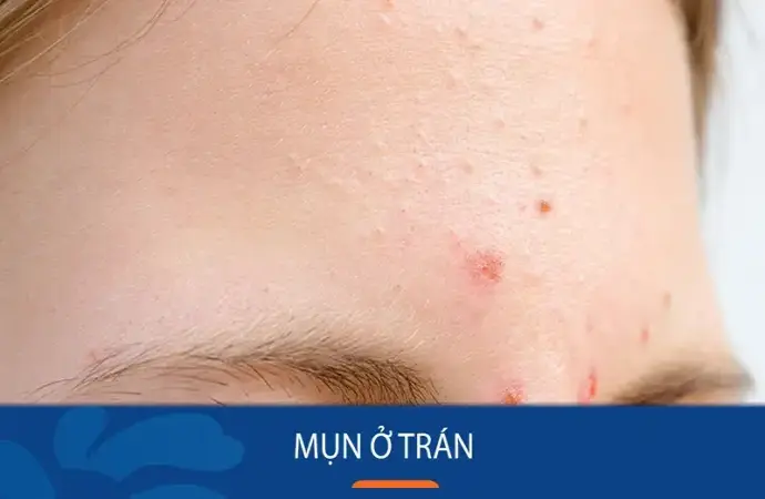 Cách trị mụn trên trán nhanh chóng hiệu quả cho mọi loại da