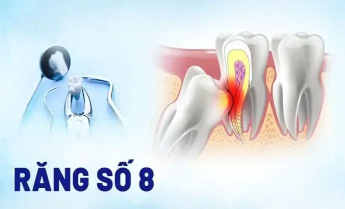 Tác hại của răng số 8: Nhận biết và phòng ngừa hiệu quả