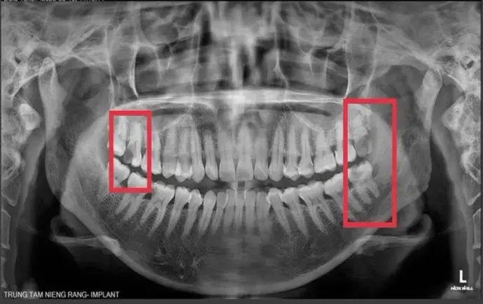 Tác hại răng khôn và những sự thật khiến bạn lo lắng