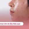 Bí quyết chọn serum trị mụn cho da dầu hiệu quả nhất 2026