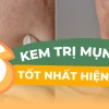 Bí quyết trị mụn ẩn cho da dầu hiệu quả ngay tại nhà