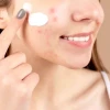 Các Bước Skincare Cho Da Dầu Mụn Đúng Chuẩn Chuyên Gia 2026