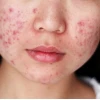 Miếng Dán Mụn Hàn Quốc: Giải Pháp Hiệu Quả Cho Làn Da Sạch Mụn