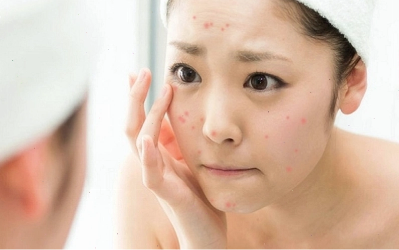 Chăm sóc da mụn tuổi dậy thì