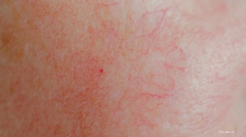Corticoid có thể gây ra tình trạng giãn mạch máu và rạn da