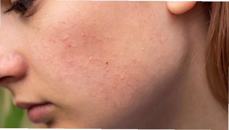 Da dầu dễ bị mụn ẩn do tuyến bã nhờn hoạt động mạnh