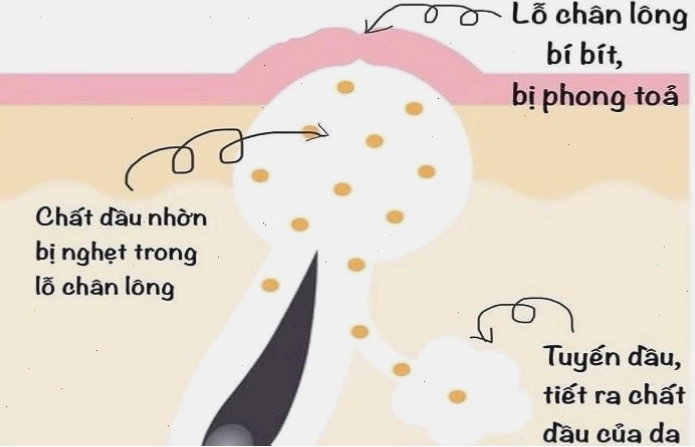 Da dầu dễ nổi mụn do tuyến bã nhờn hoạt động mạnh