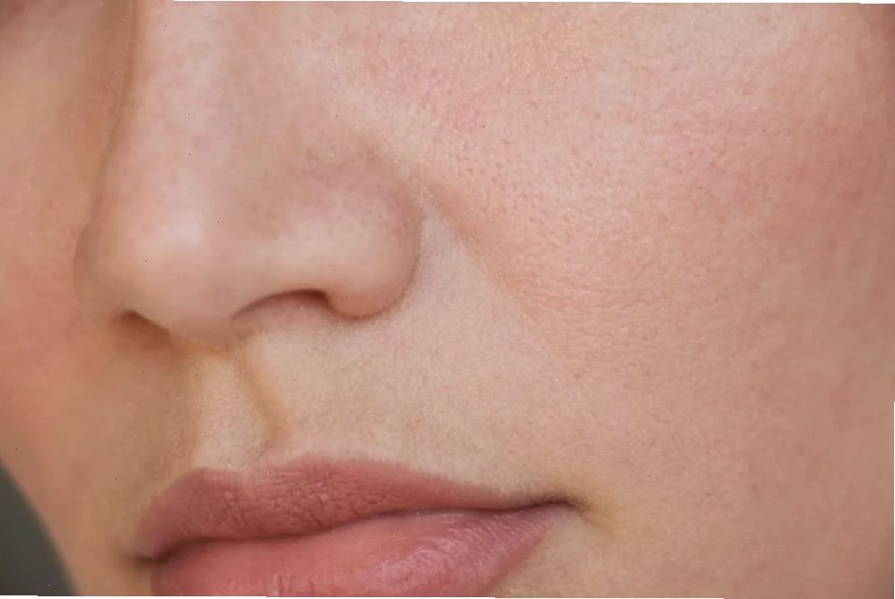 Da dầu mụn với lỗ chân lông to