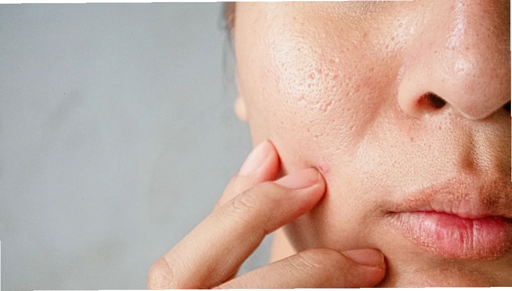 Da dầu với lỗ chân lông to và mụn viêm đỏ