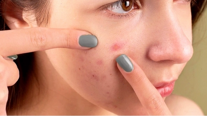 Da sau khi peel có thể trở nên nhạy cảm và cần chế độ chăm sóc đặc biệt