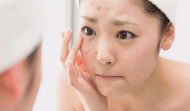 Giải thích tại sao da dầu mụn lại dễ nổi mụn khi dùng kem chống nắng không phù hợp