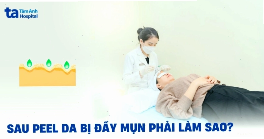 Hiện tượng peel da đẩy mụn là gì và tại sao lại xảy ra