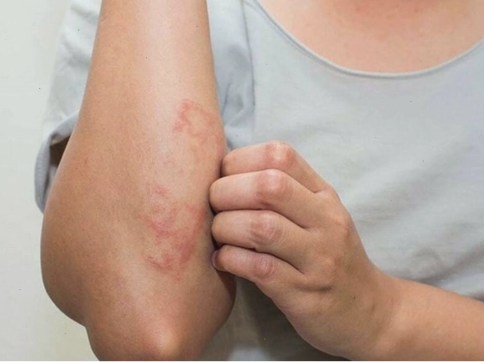 Hóa chất trong nước ô nhiễm gây kích ứng và khô da