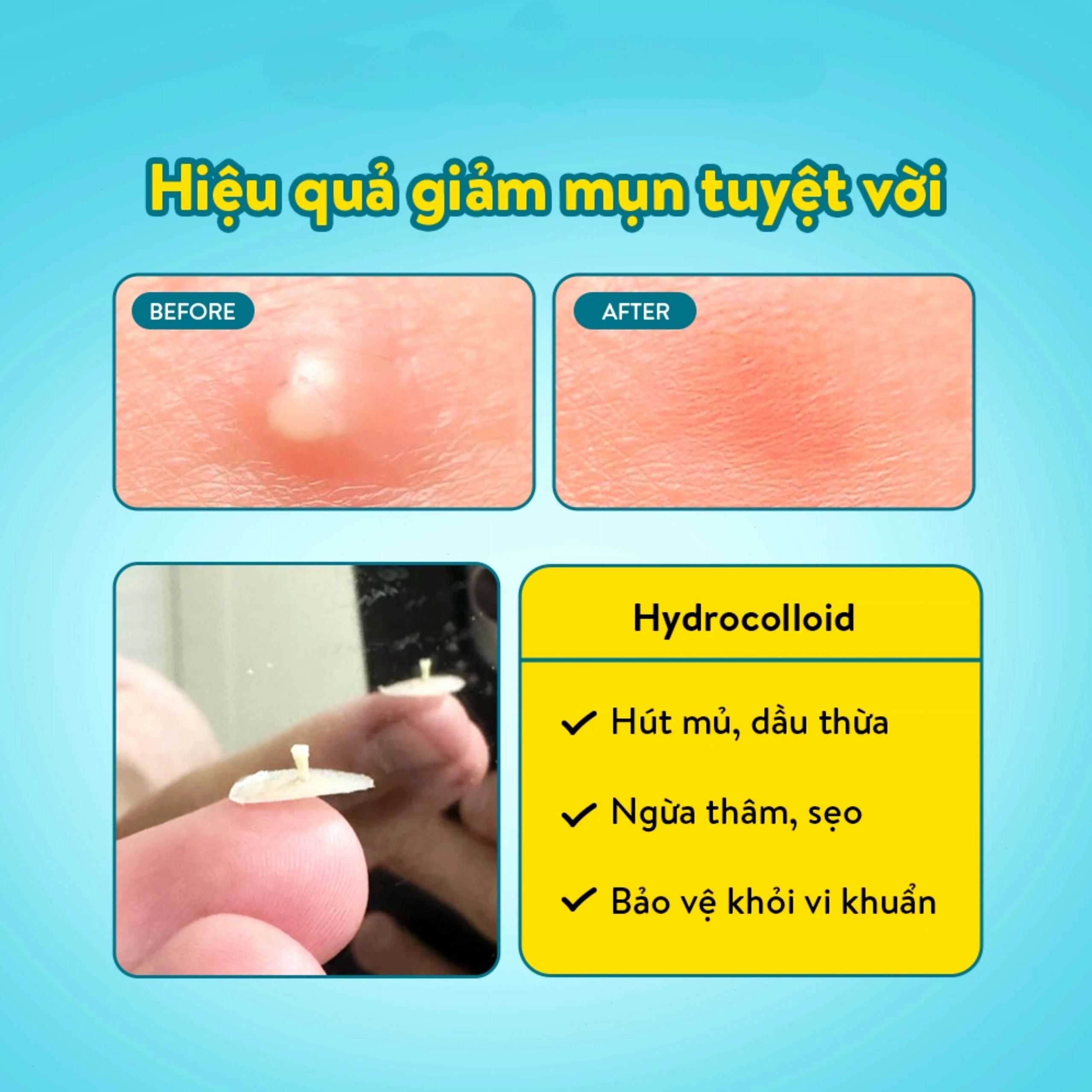 Hướng dẫn sử dụng miếng dán mụn đúng cách