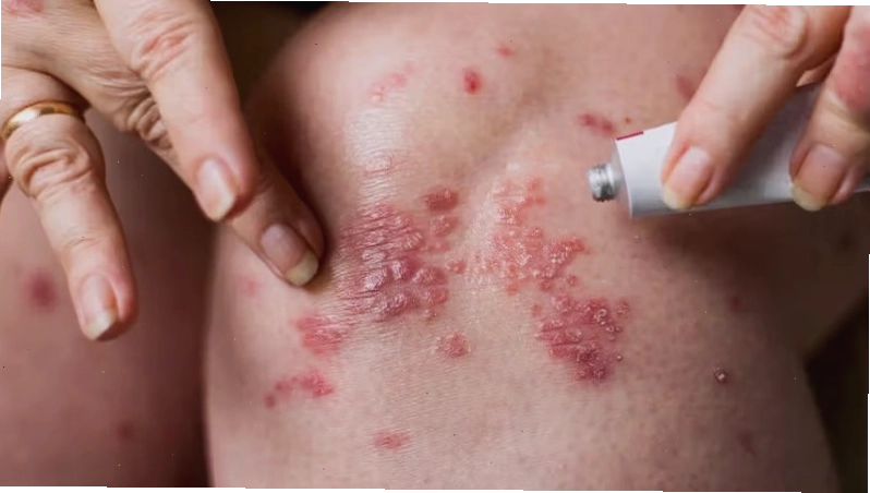 Lạm dụng corticoid làm suy yếu phản ứng miễn dịch tự nhiên của da