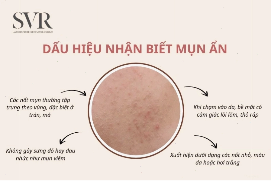 Mặt nạ đất sét giúp hút dầu thừa và làm sạch mụn ẩn