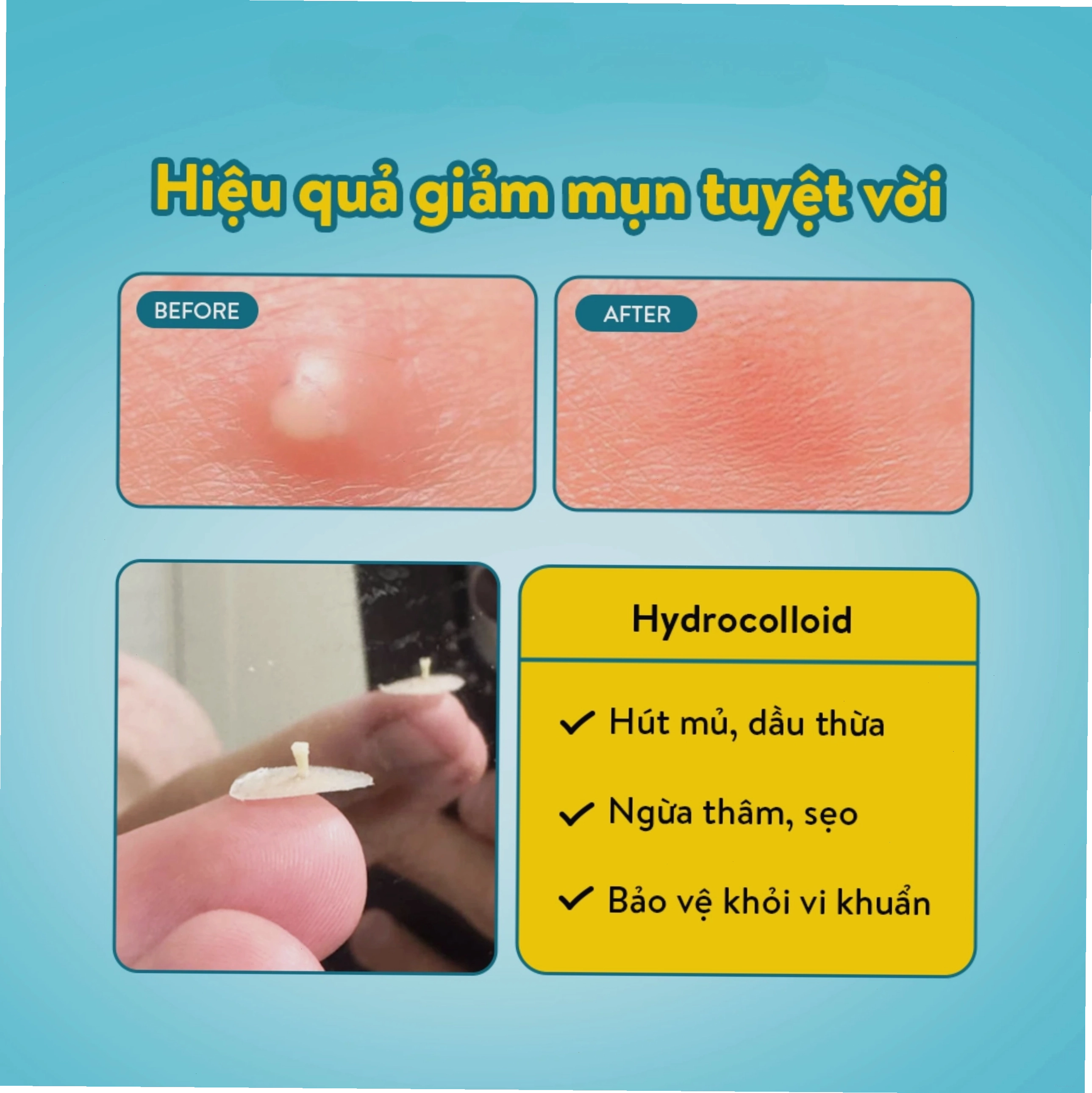 Miếng dán mụn Derma Angel ban ngày mỏng nhẹ, khó nhận biết