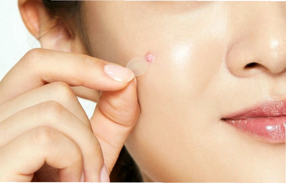 Miếng dán mụn được dùng để điều trị mụn trứng cá