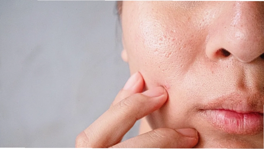 Minh họa da dầu và tình trạng lỗ chân lông to