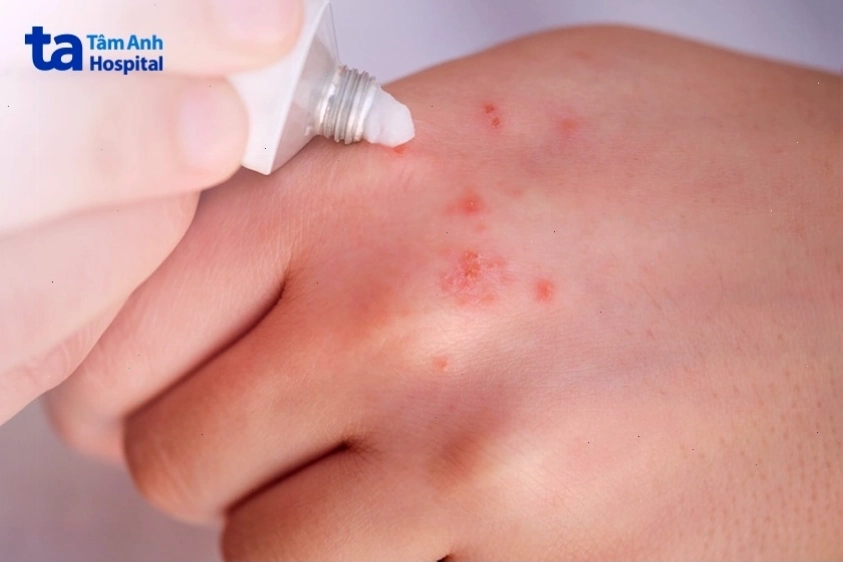 Người bệnh chỉ cần dùng một lớp mỏng
