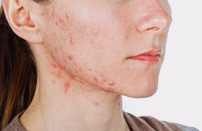 Nước bẩn chứa vi khuẩn có thể gây hại cho da