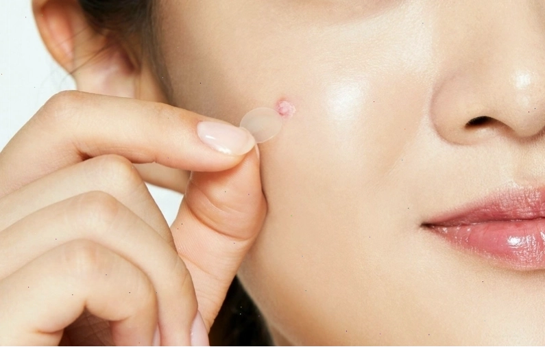 Phân loại miếng dán mụn và cách sử dụng hiệu quả