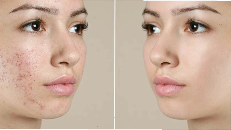 Quá trình peel da trị mụn giúp loại bỏ tế bào chết và bã nhờn