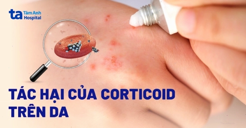 Tác hại của Corticoid trên da