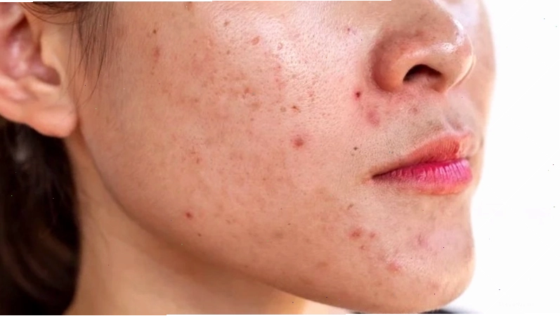 Tầm quan trọng của việc chọn sữa rửa mặt phù hợp cho da nhạy cảm và mụn