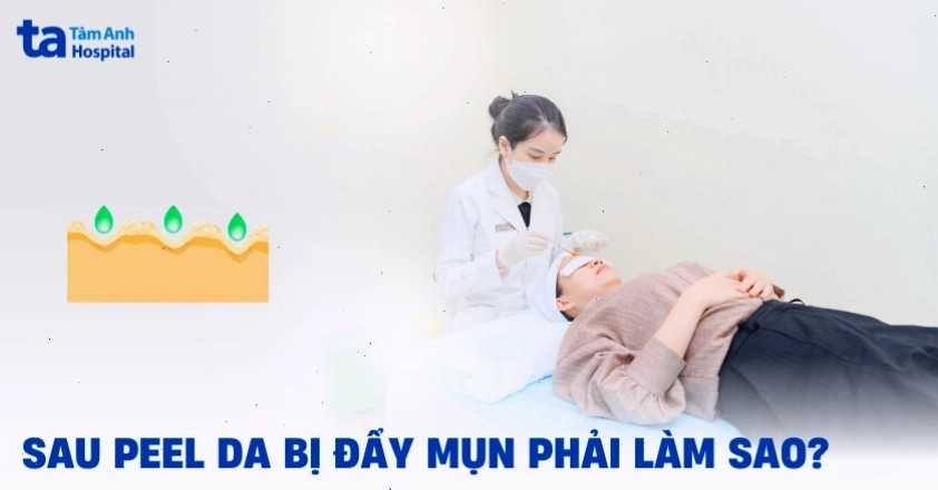 Thời gian bong da sau peel da trị mụn có thể kéo dài từ 3-7 ngày