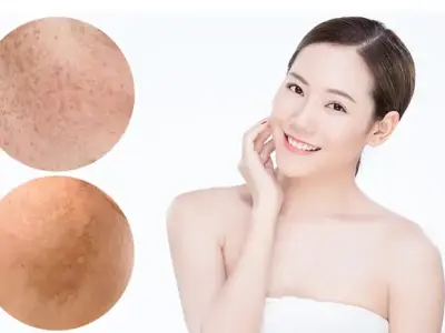 Các bước chăm sóc da nám hiệu quả giúp làn da sáng mịn